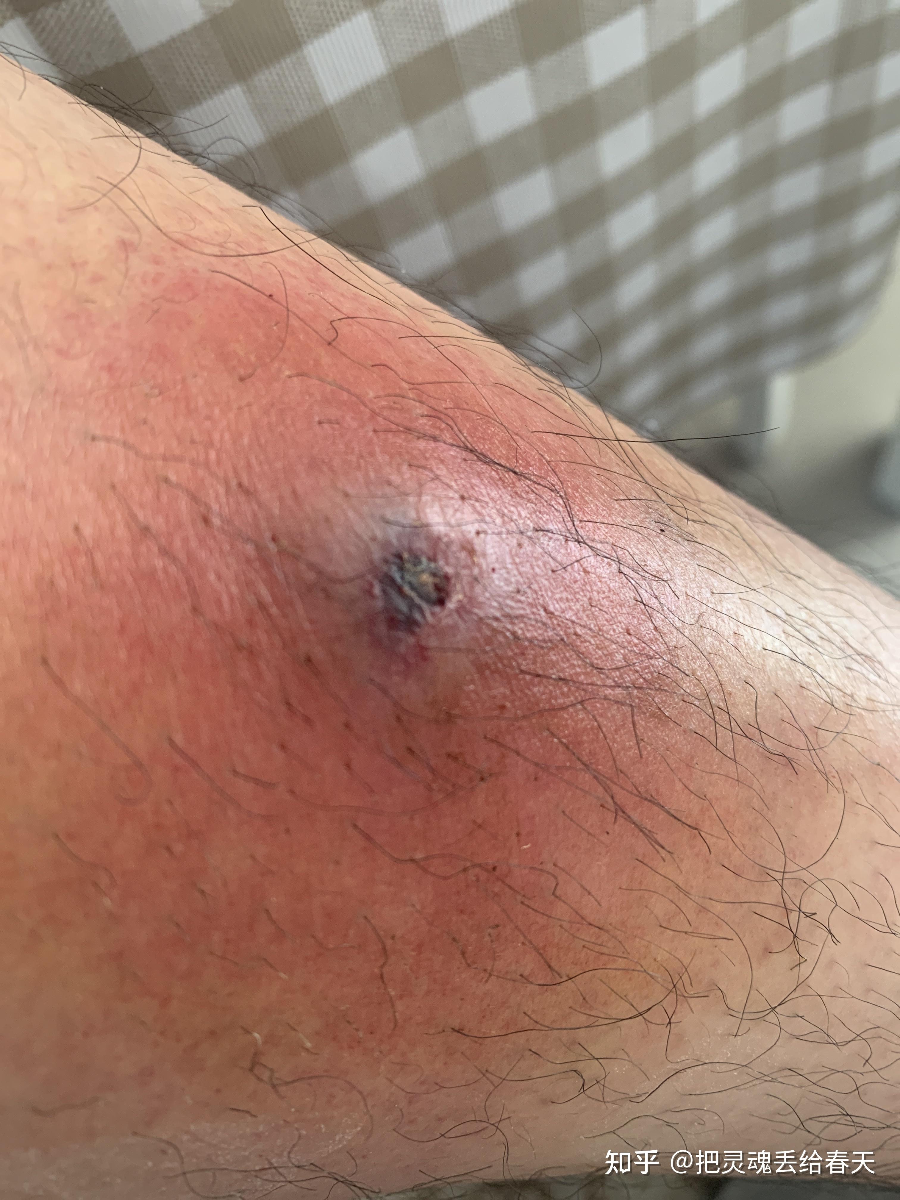 人体的火疖子 (化脓性毛囊及毛囊深部周围组织的感染) 能有多大?