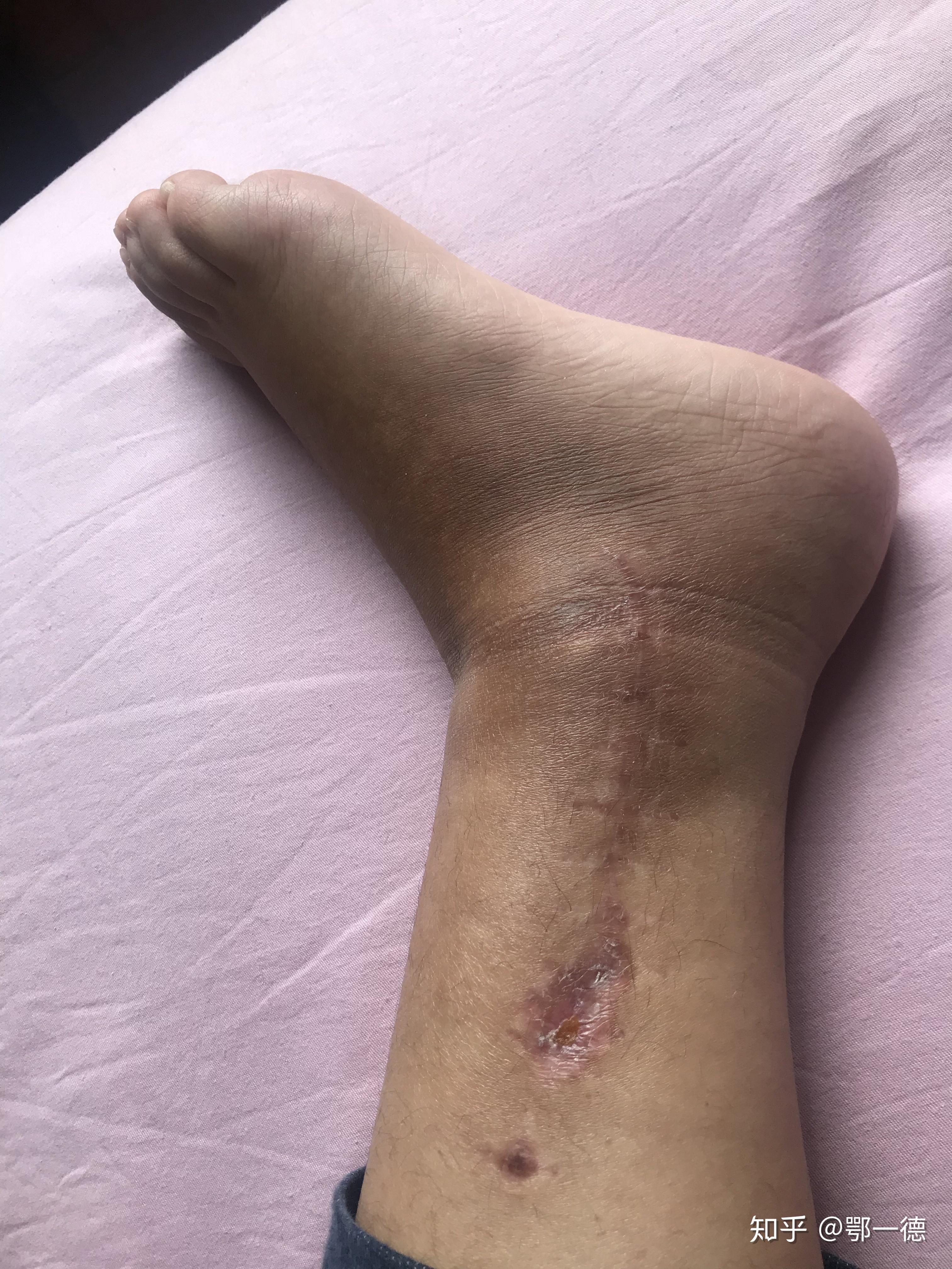 右内踝骨折手术后是一种怎样的体验? - 知乎