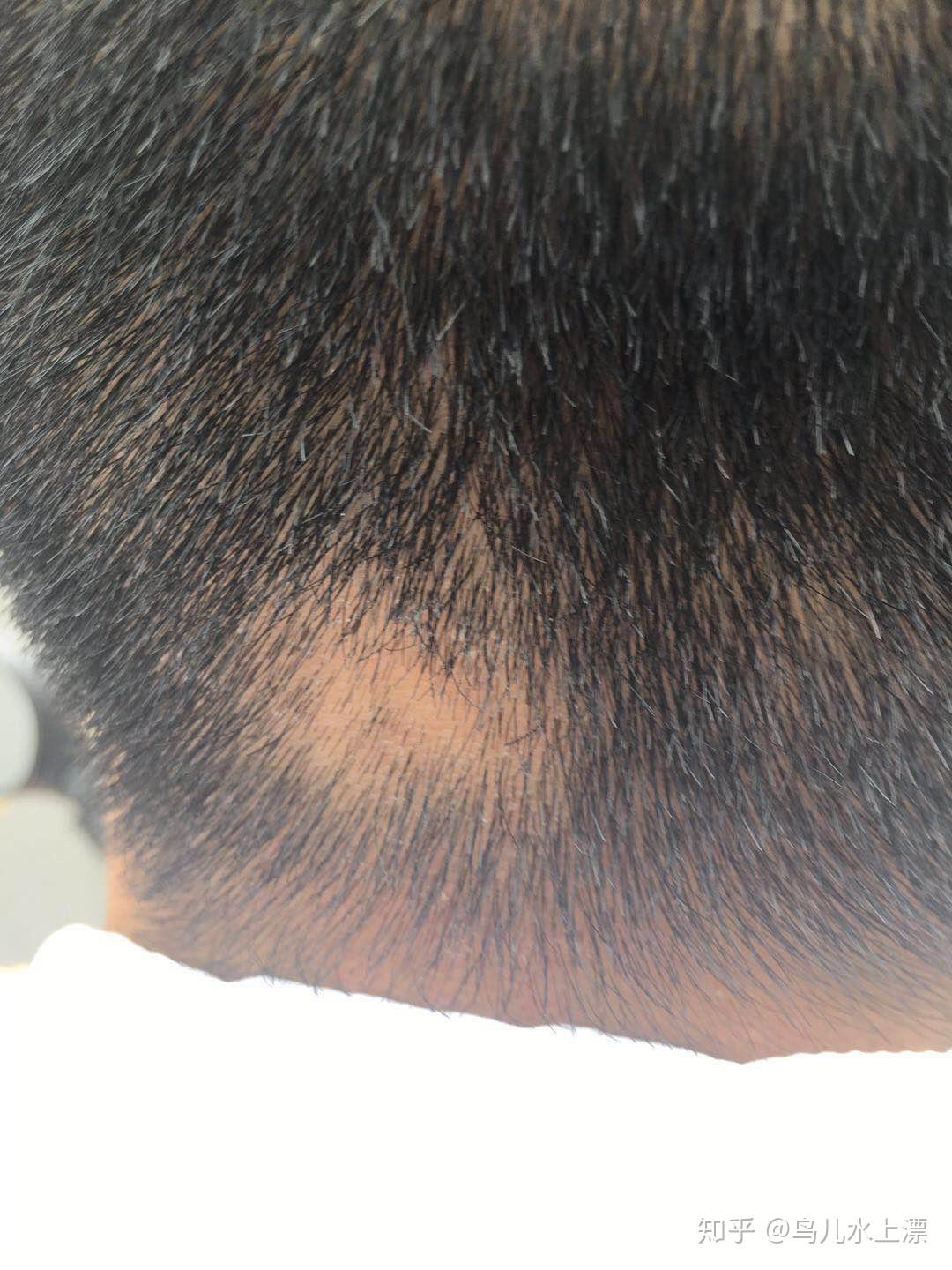 后脑勺突然少了一撮头发不痛不痒同事说了才晓得怎么处理