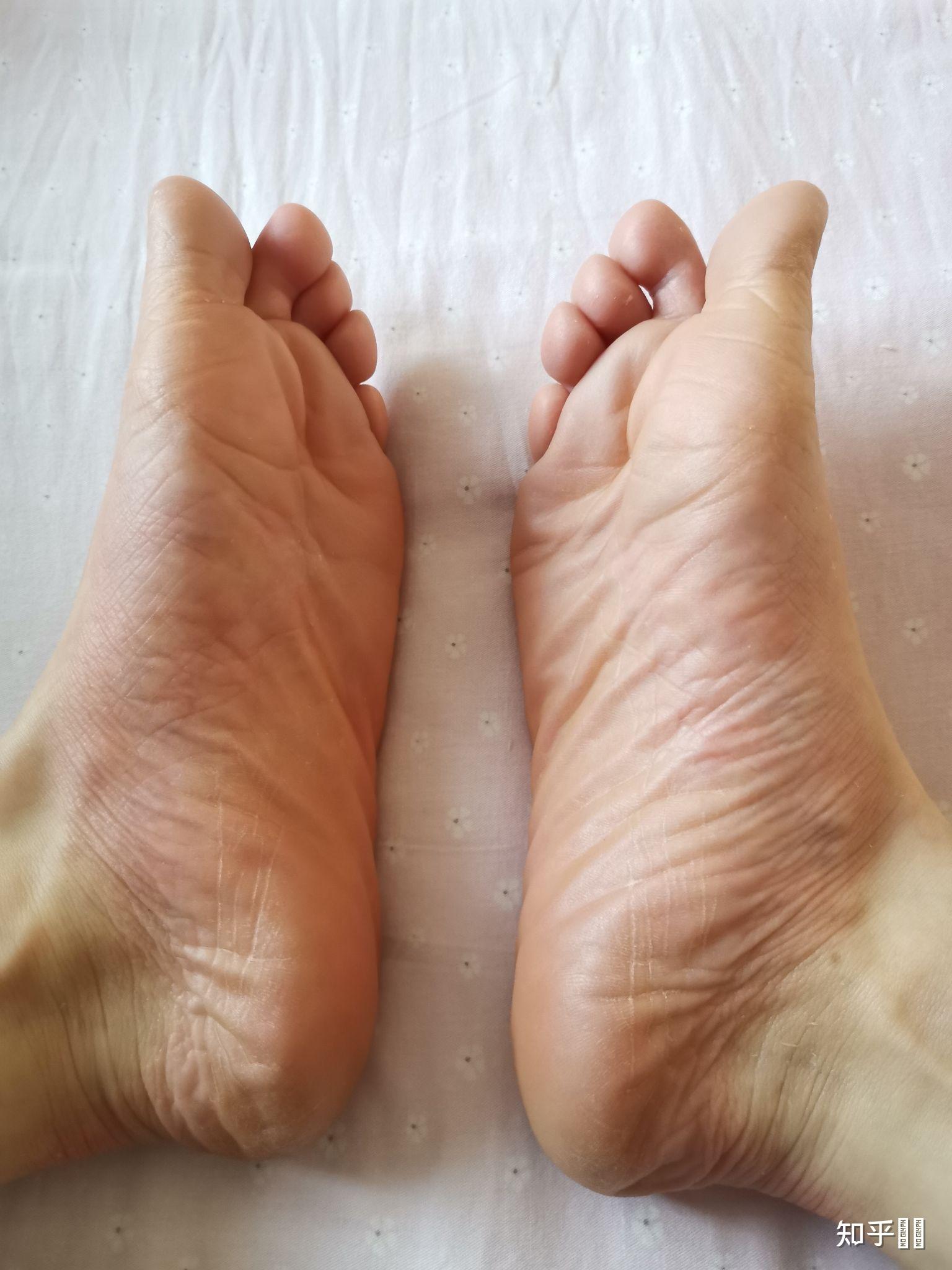 先天性就有掌跖角化症而且很严重有心理障碍