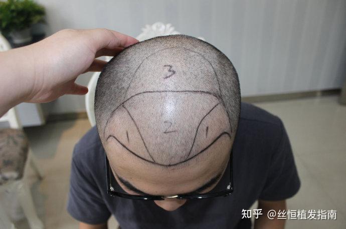 哈尔滨植发医院美利丝植发皆询A的简单介绍