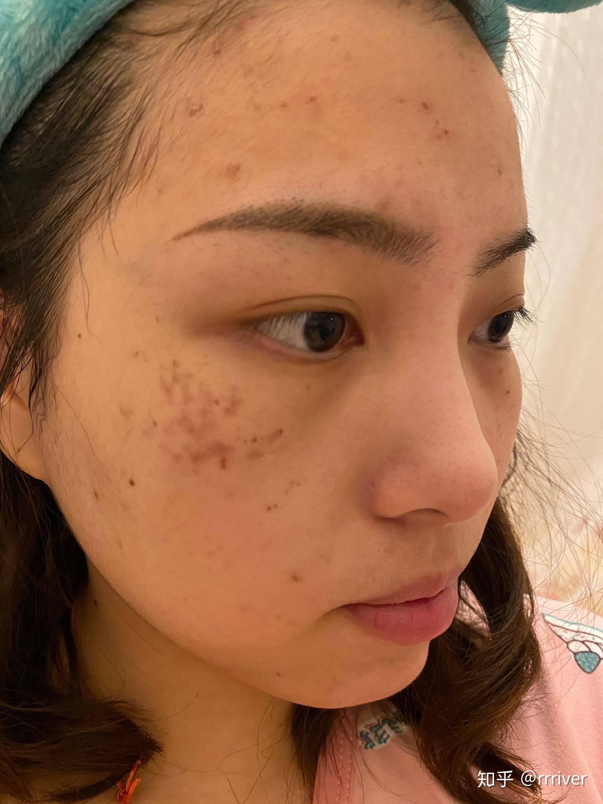 有谁褐青色痣治好过