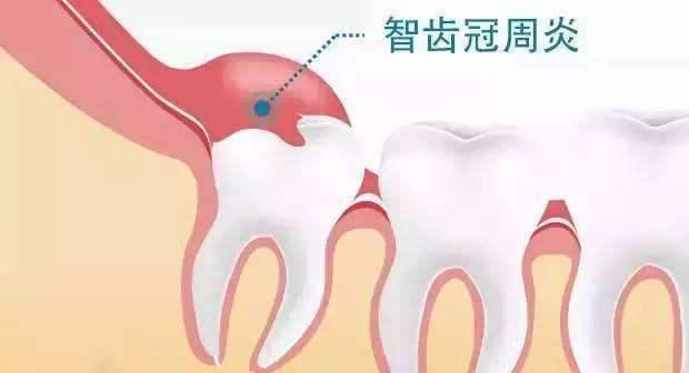 智齿冠周炎 - 知乎