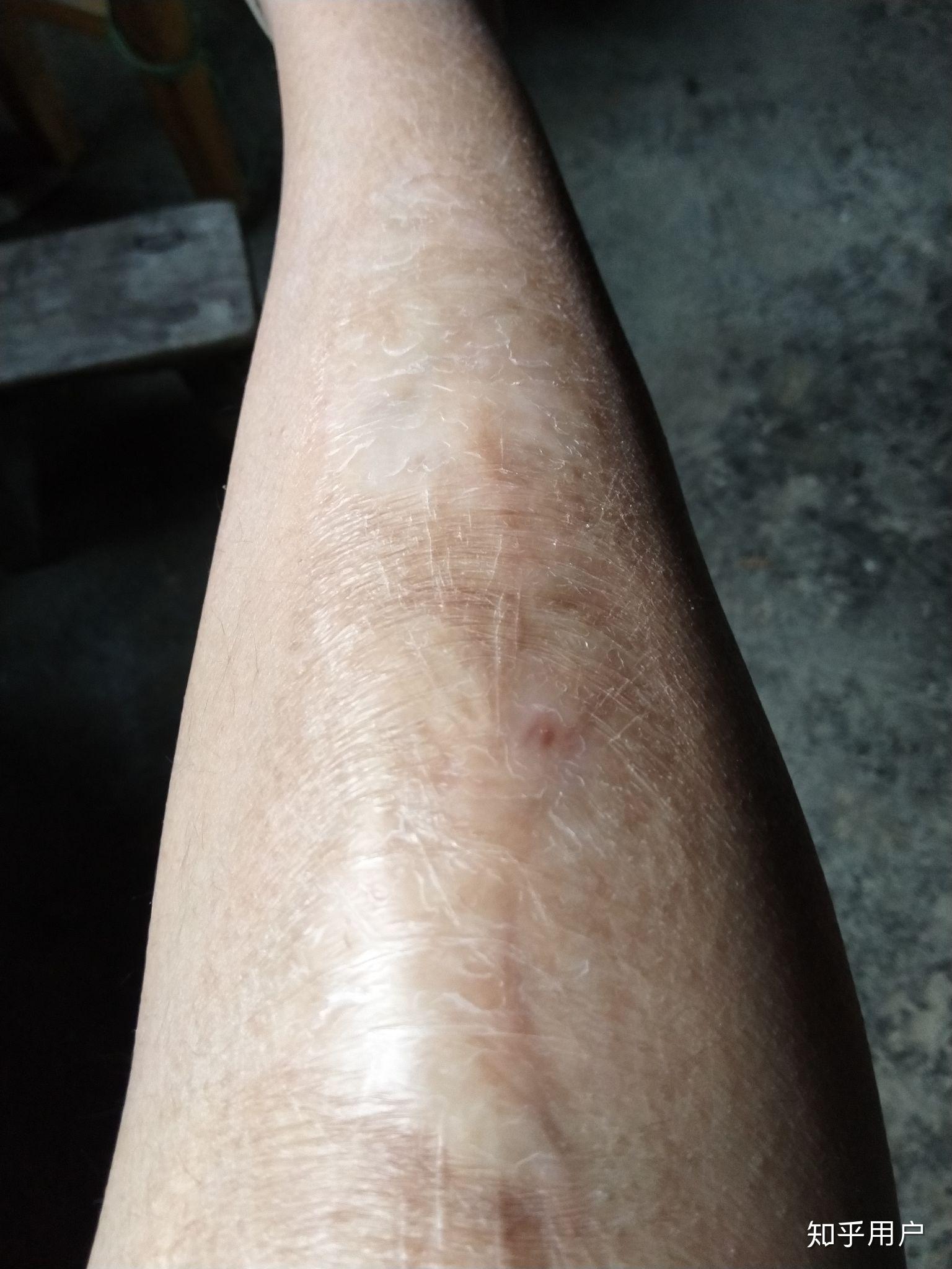 有没有人因腿上有大面积疤,十几年都没穿过短裤短裙?