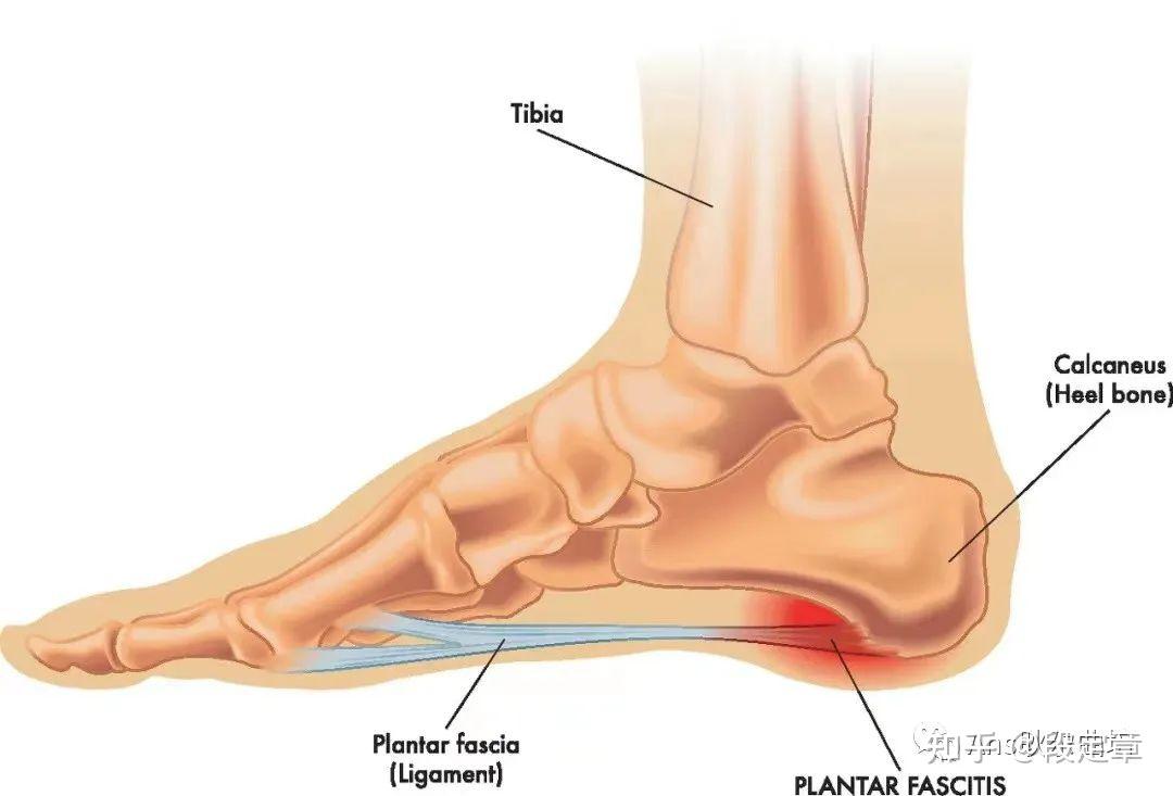 足跟痛是怎么回事