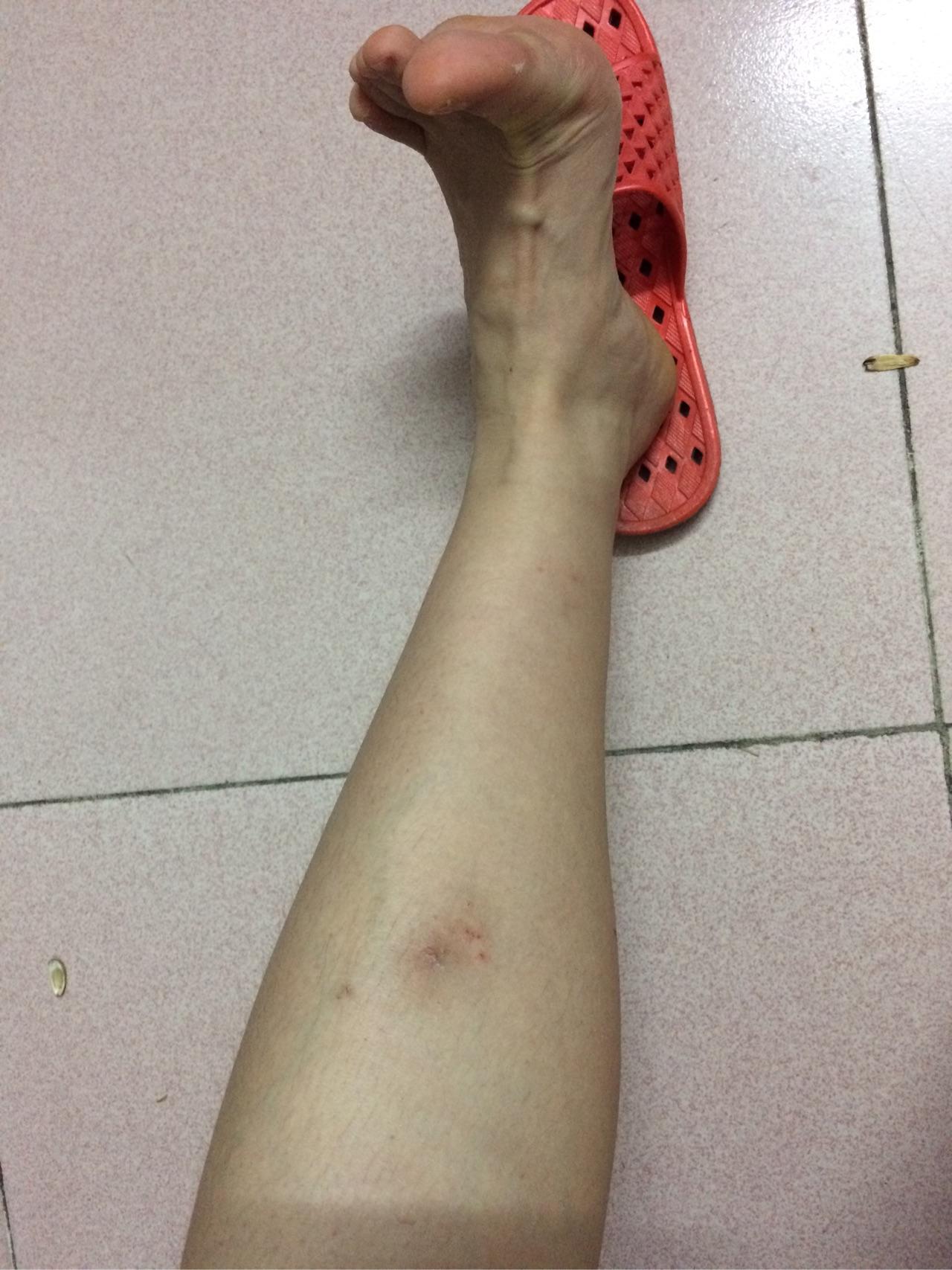 被毒蚊子咬了肿了很大一个包还很硬之后肿的包上面起了水泡挑破之后第
