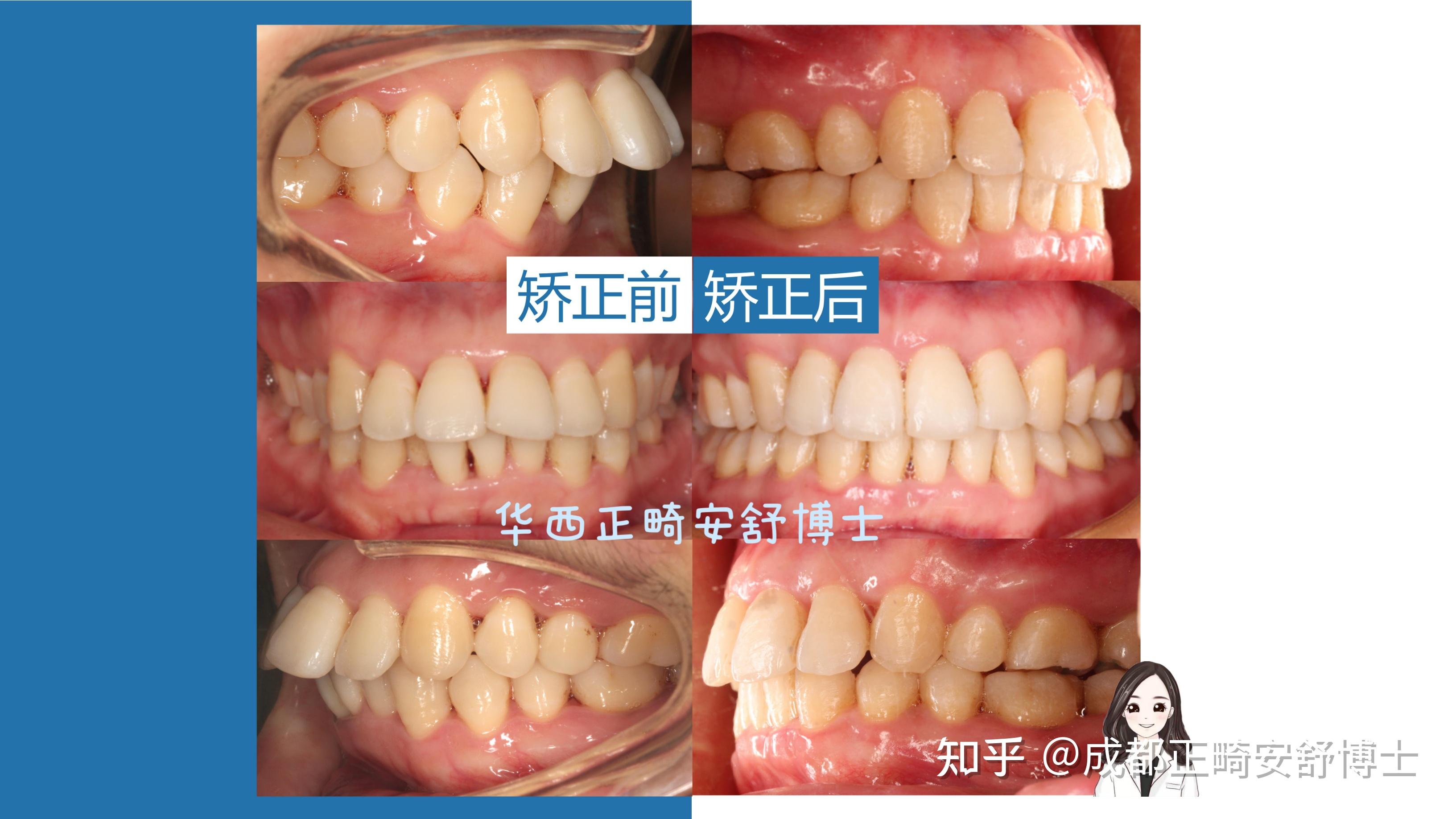 牙齿正常倾斜角度图图片