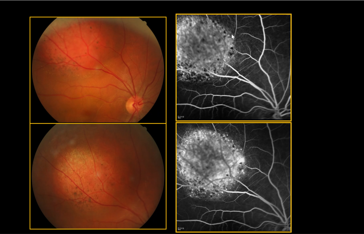 聊聊脉络膜血管瘤 - 知乎