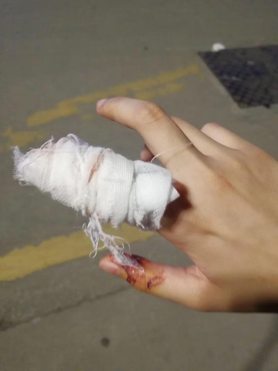 伤口拆线的时候疼吗? - 知乎