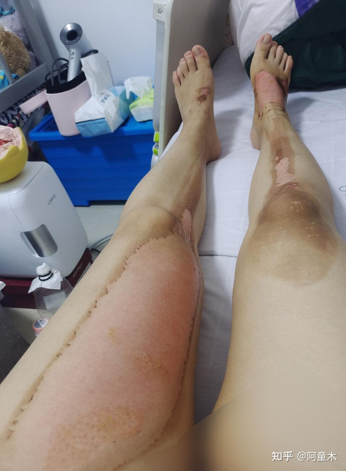 大腿和脚背被开水烫伤后恢复过程? - 知乎
