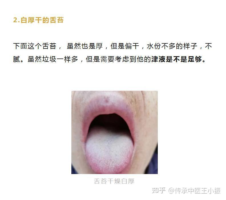 舌象分析:太吓人了,看了10个舌头,没有一个是“好”舌头! - 知乎