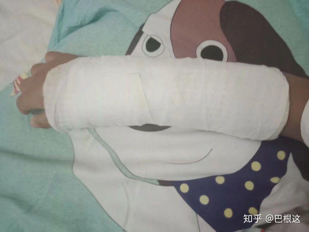 手上打石膏如何洗澡? - 知乎