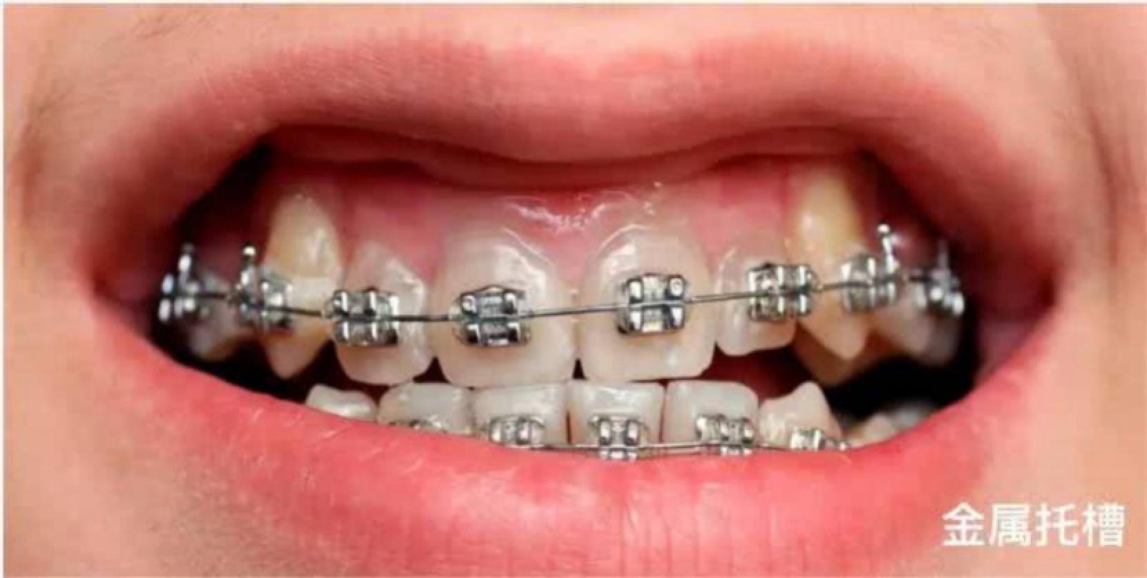 对于戴牙套的人来说,冲牙器和电动牙刷哪一个更需要?