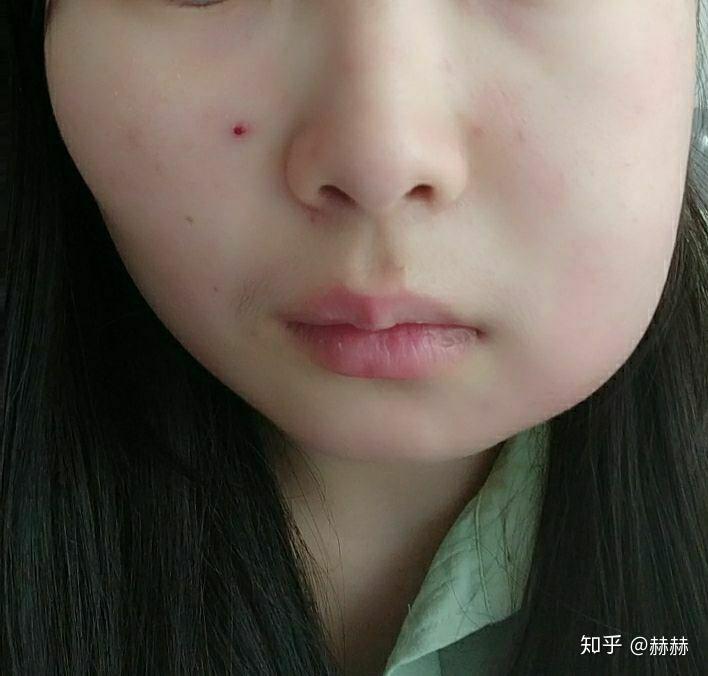 拔水平阻生智齿,术后第二天脸肿了,请问几天能消肿? - 知乎