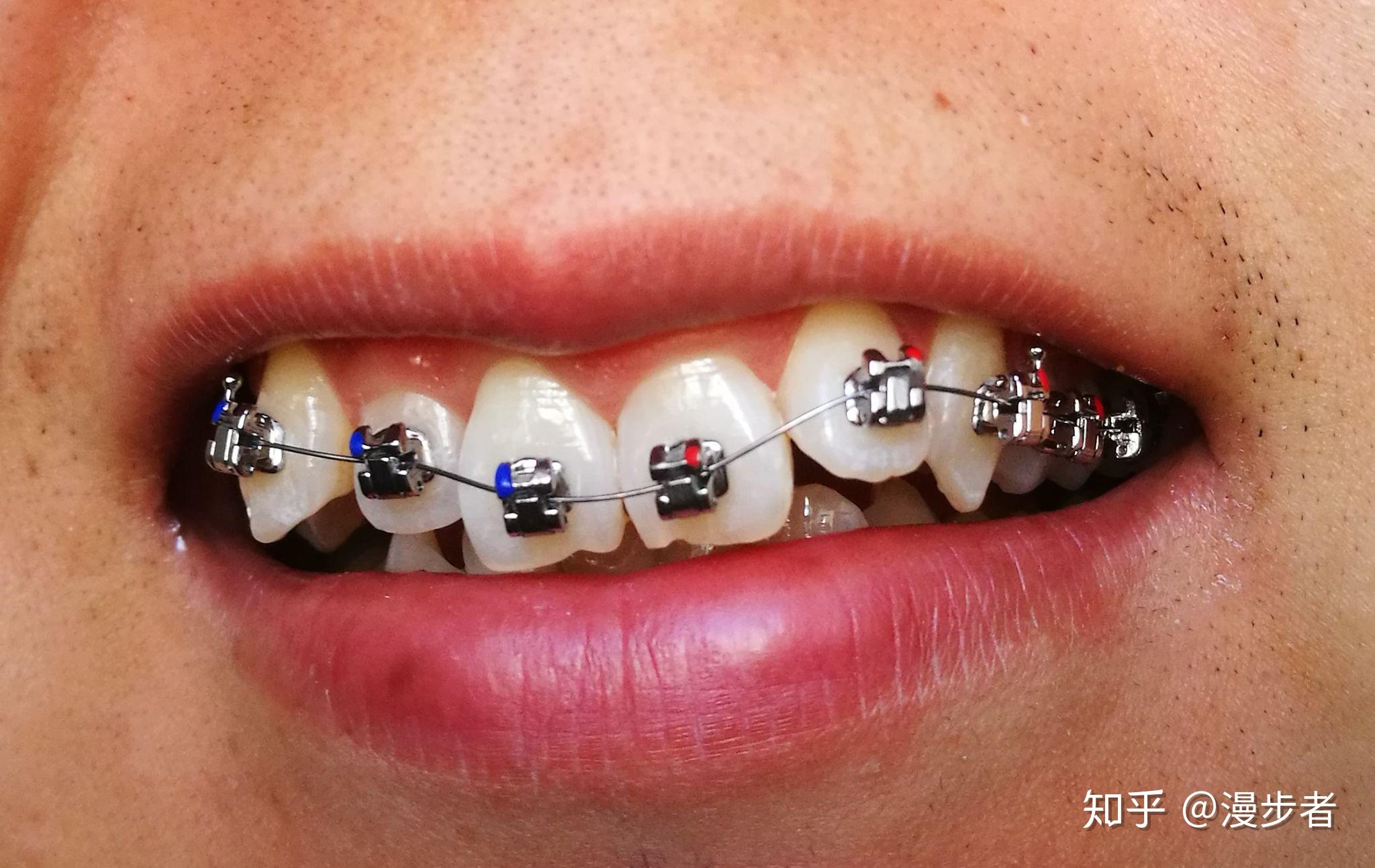 正畸用的进口的自锁托槽和国产的自锁托槽有什么区别? - 知乎