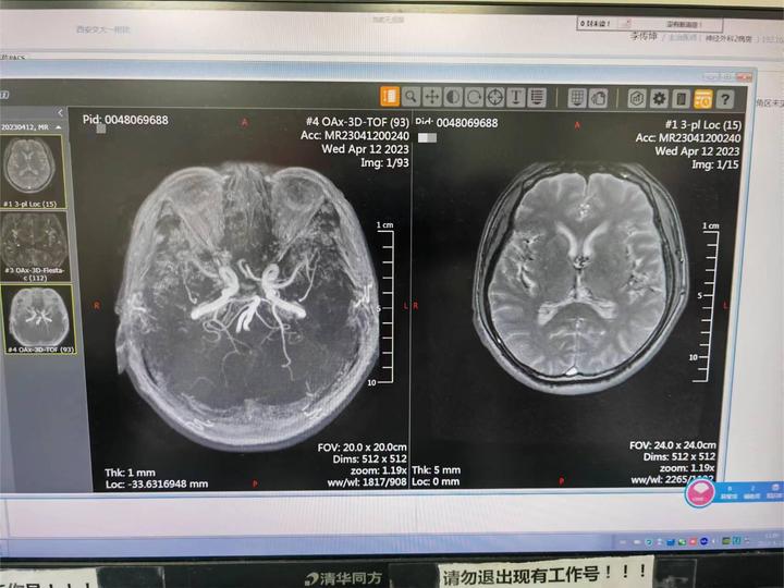 花甲之年的他一刷牙就痛,神奇MVD助力三叉神经痛患者重获笑容…… - 知乎