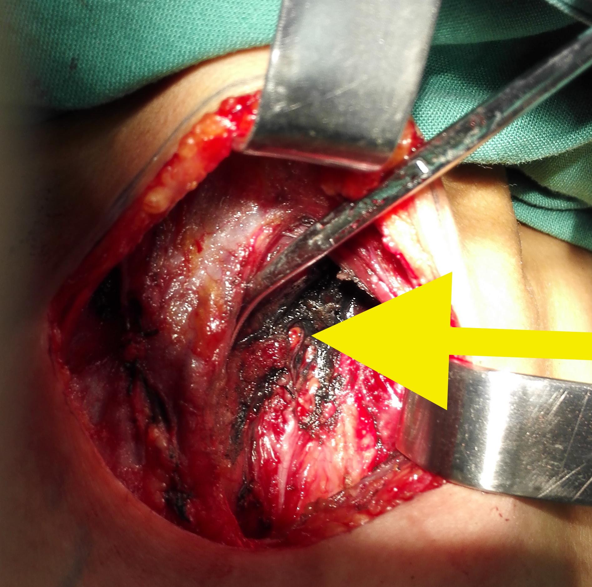 甲状腺结节怎么确诊良性还是恶性? - 知乎