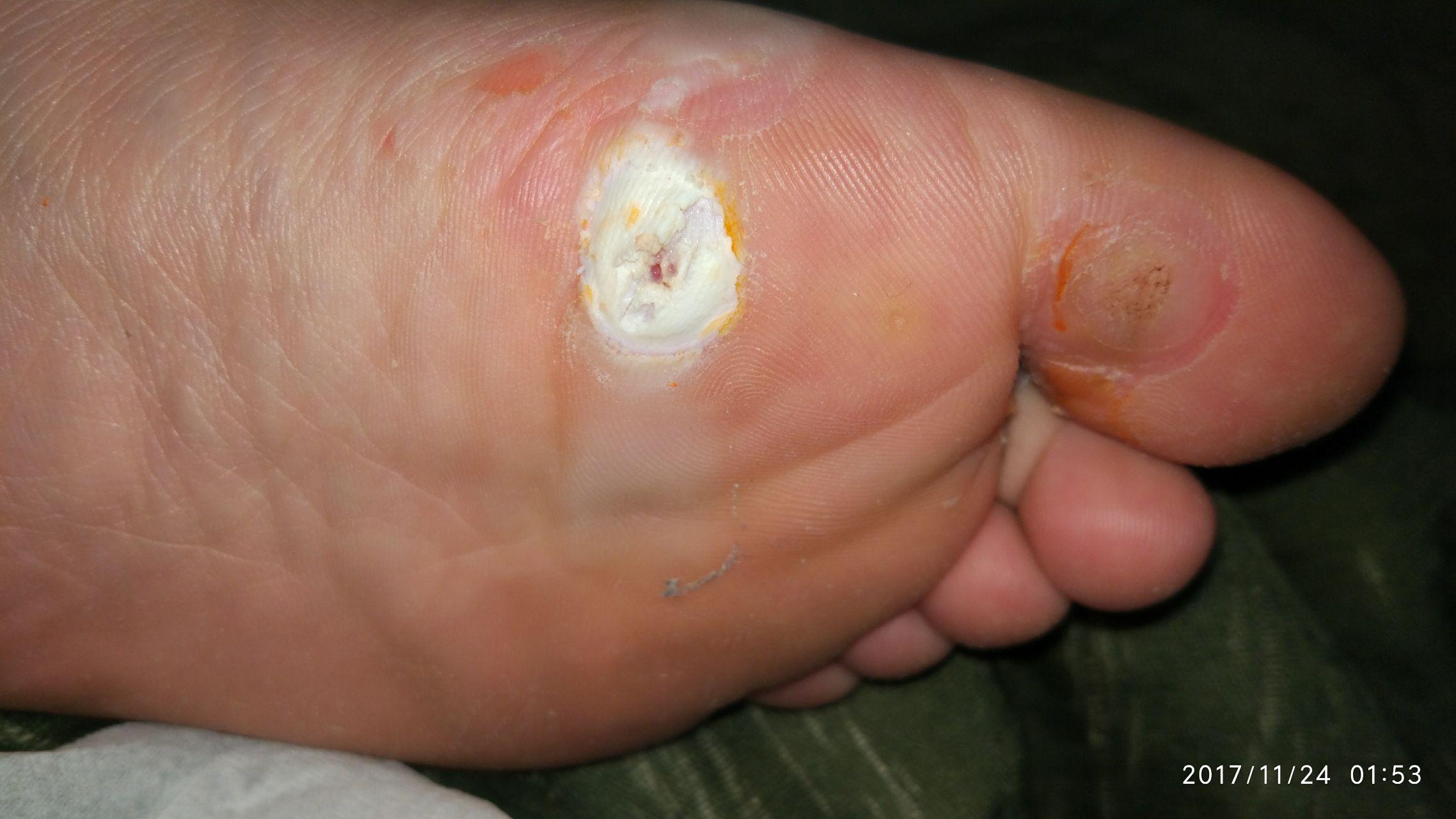 鸡眼怎么治好? - 知乎