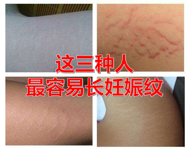这三种人最容易长妊娠纹了,一定要提前做好妊娠纹预防!