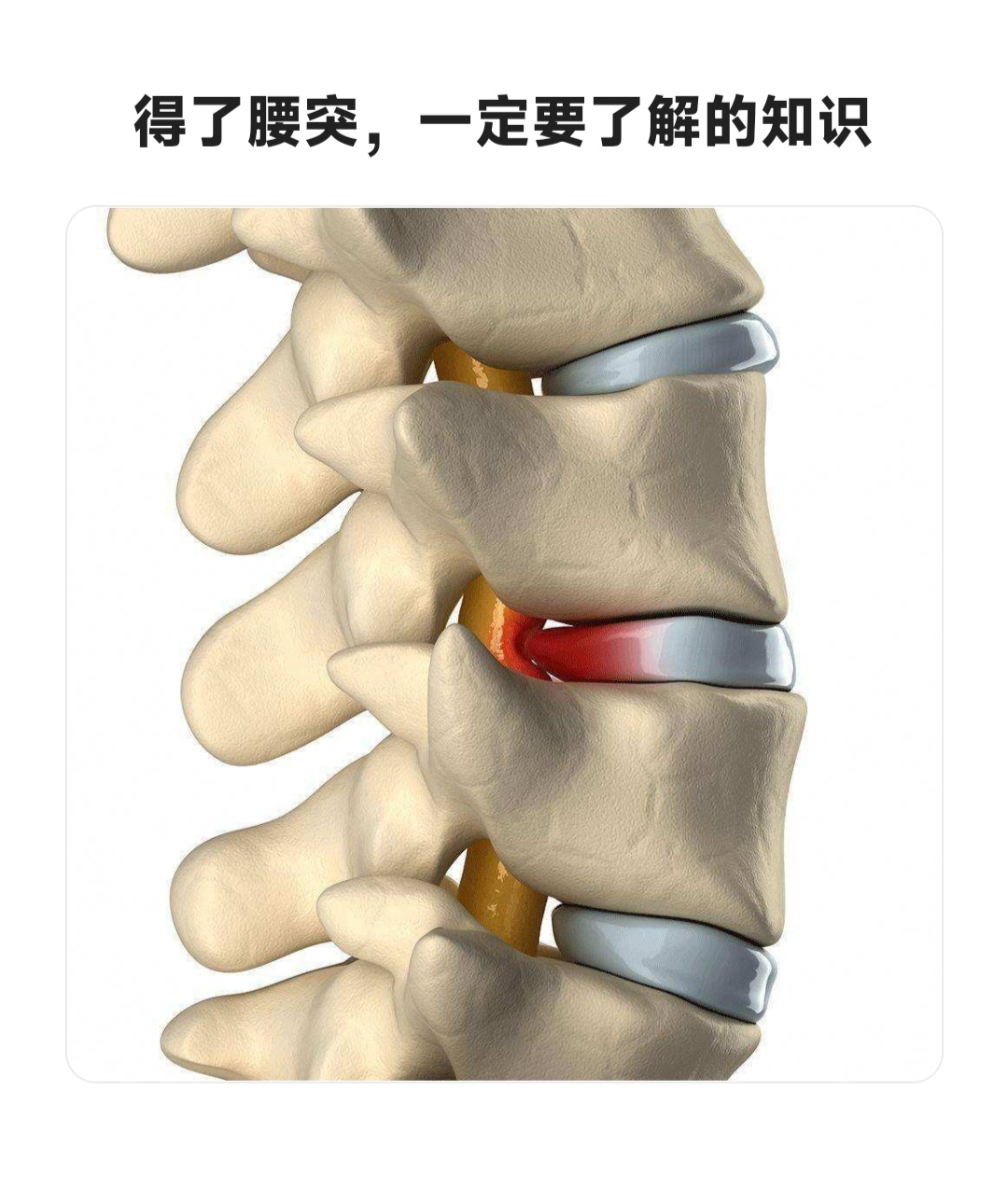腰间盘突出养了两三个月了腿基本不会疼了腰偶尔会疼走多了腿会很麻下