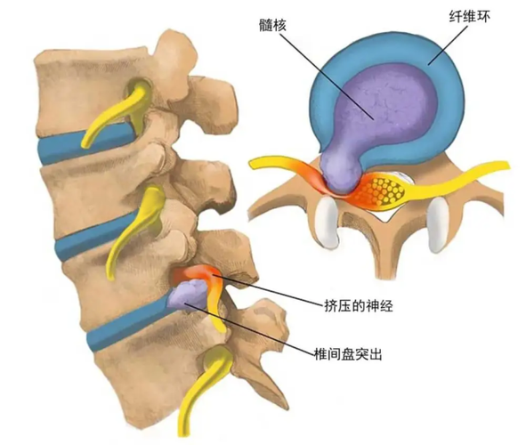 腰5骶1椎间盘位置图图片