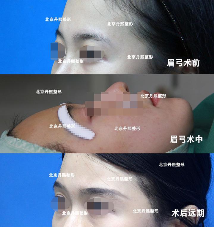 丹熙魏洁谈假体眉弓可以跟额颞部脂肪填充一起做么? - 知乎