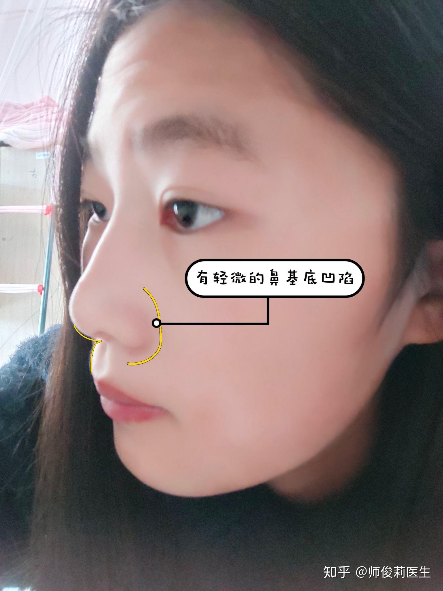 我的鼻子是塌鼻子为什么我侧脸那么丑哪里出问题了