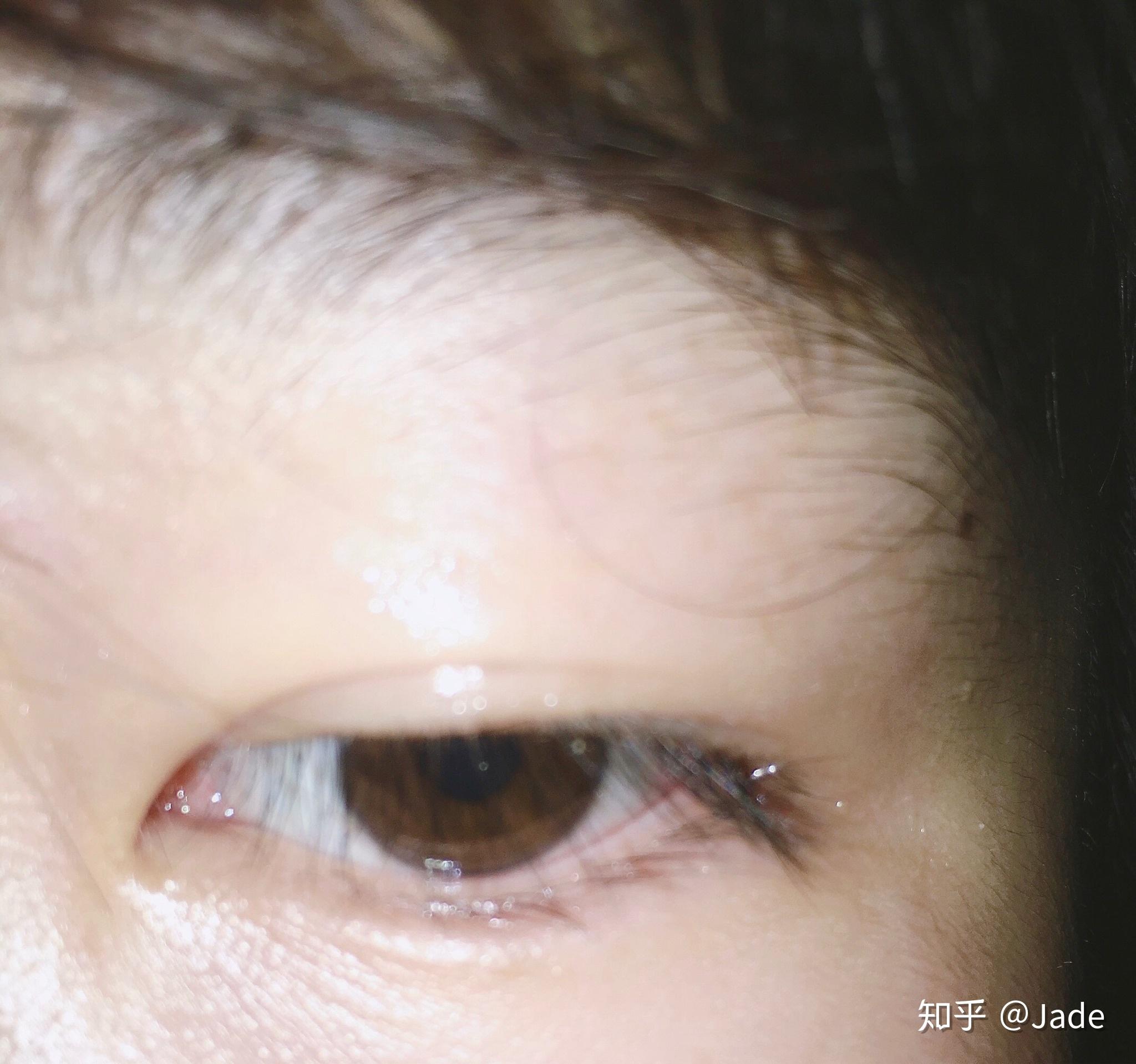 抑郁症患者的眼睛是什么样的