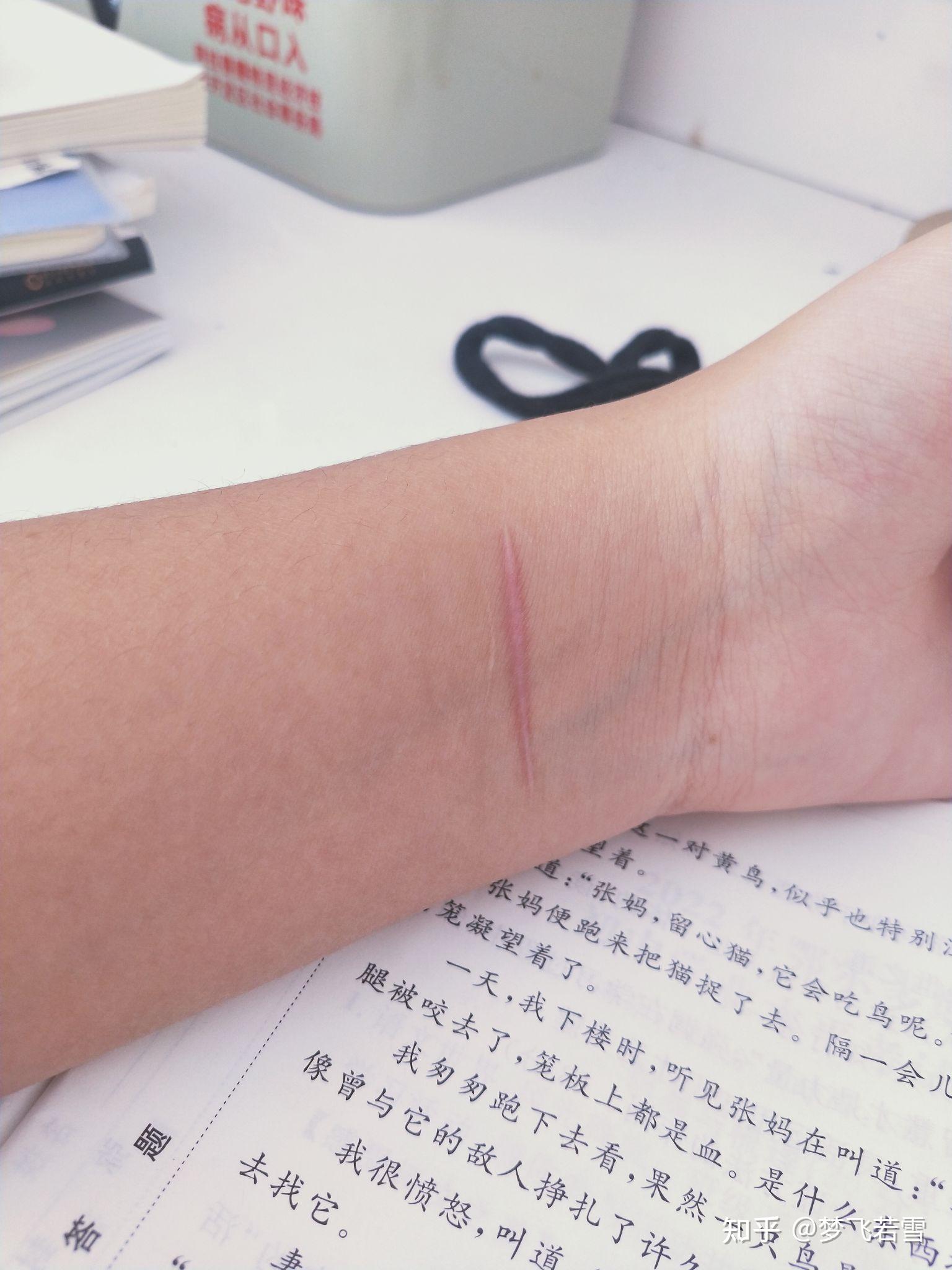 对于一个割腕过的人,未来如何向别人解释这道疤的由来?