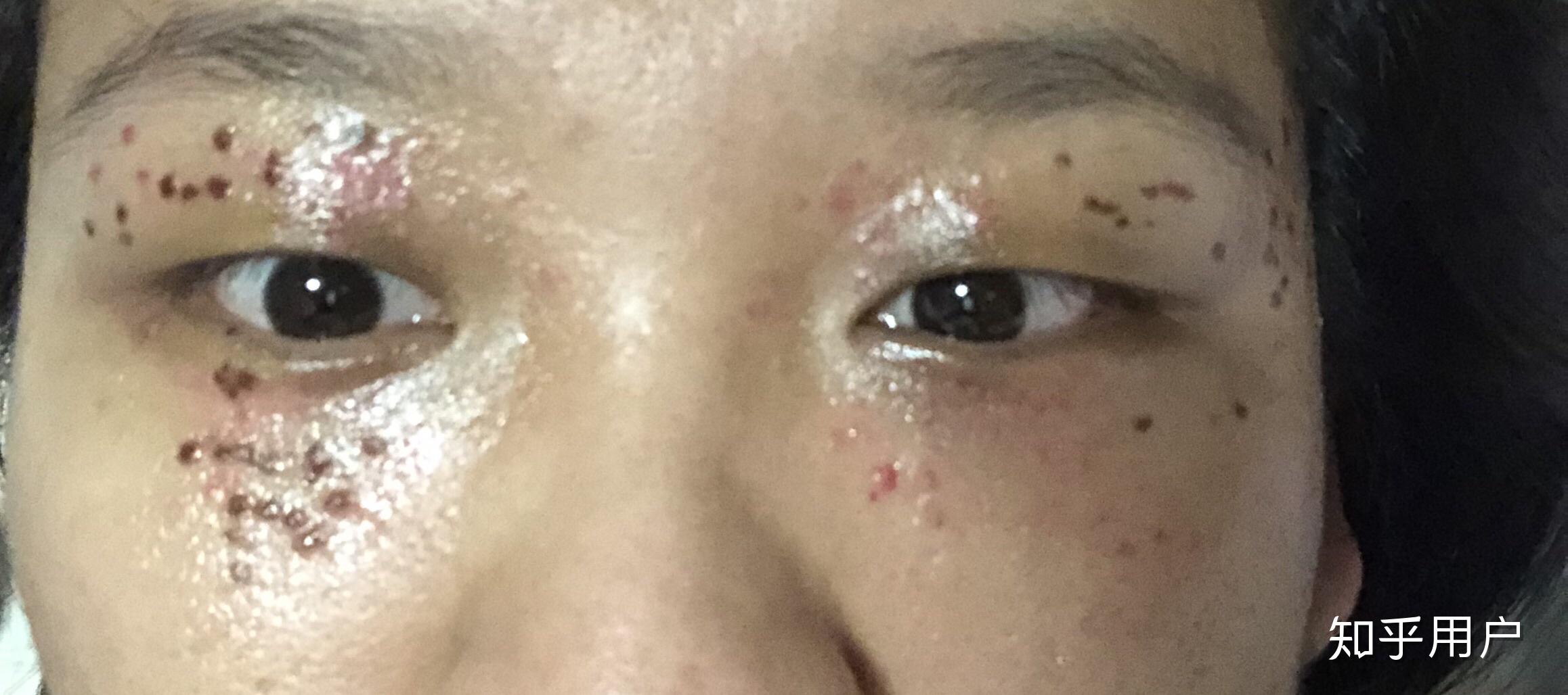 眼睛周围长了很多汗管瘤,怎么办?