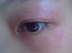 眼睛周围过敏红肿痒怎么办?长沙皮肤病医院解答