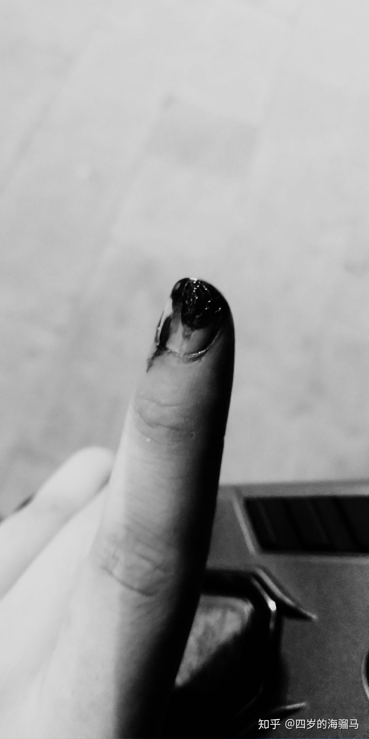 切菜的时候把手指甲切掉了一半血流不止英国的医生只用温水冲了一下就