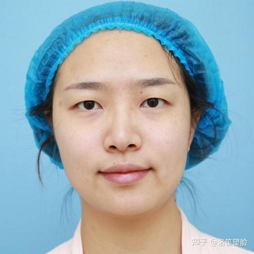 单眼皮眼距近怎么改善? - 知乎
