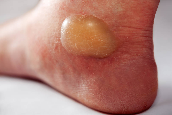 脚底水泡怎么处理?对症治疗很重要