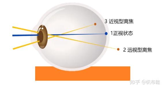 儿童近视选普通眼镜,还是离焦镜? - 知乎