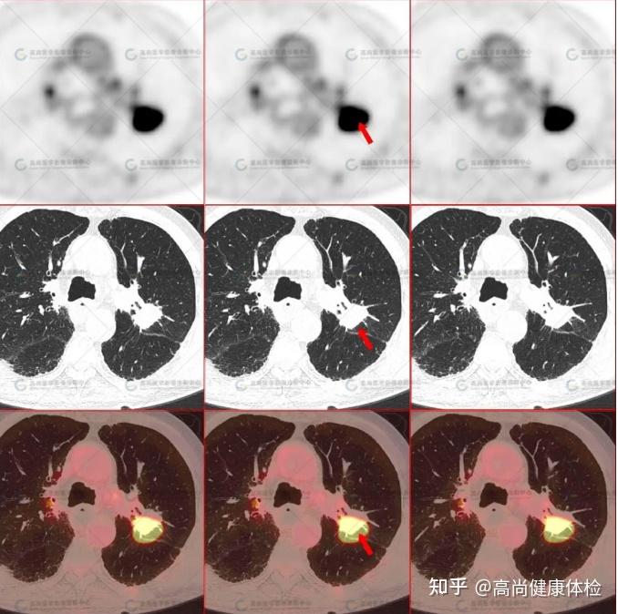 77岁男性，PET/CT诊断食管癌术后左肺上叶鳞癌1例 - 知乎