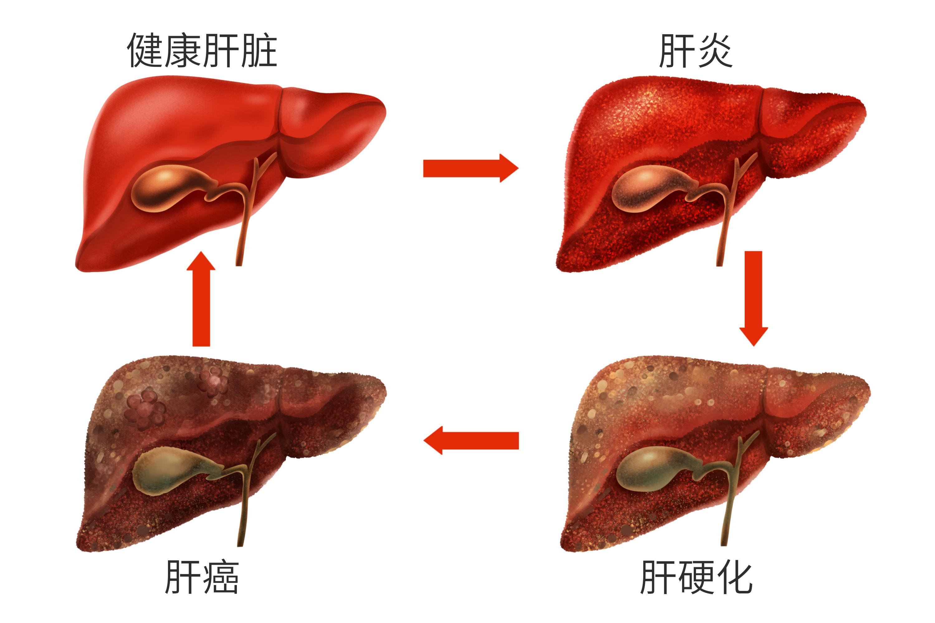 得了乙肝,一定会转变为肝癌吗?