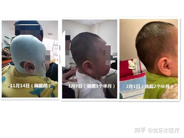头颅畸形—舟状头 - 知乎