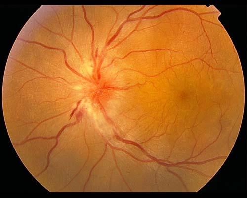 视网膜静脉周围炎?