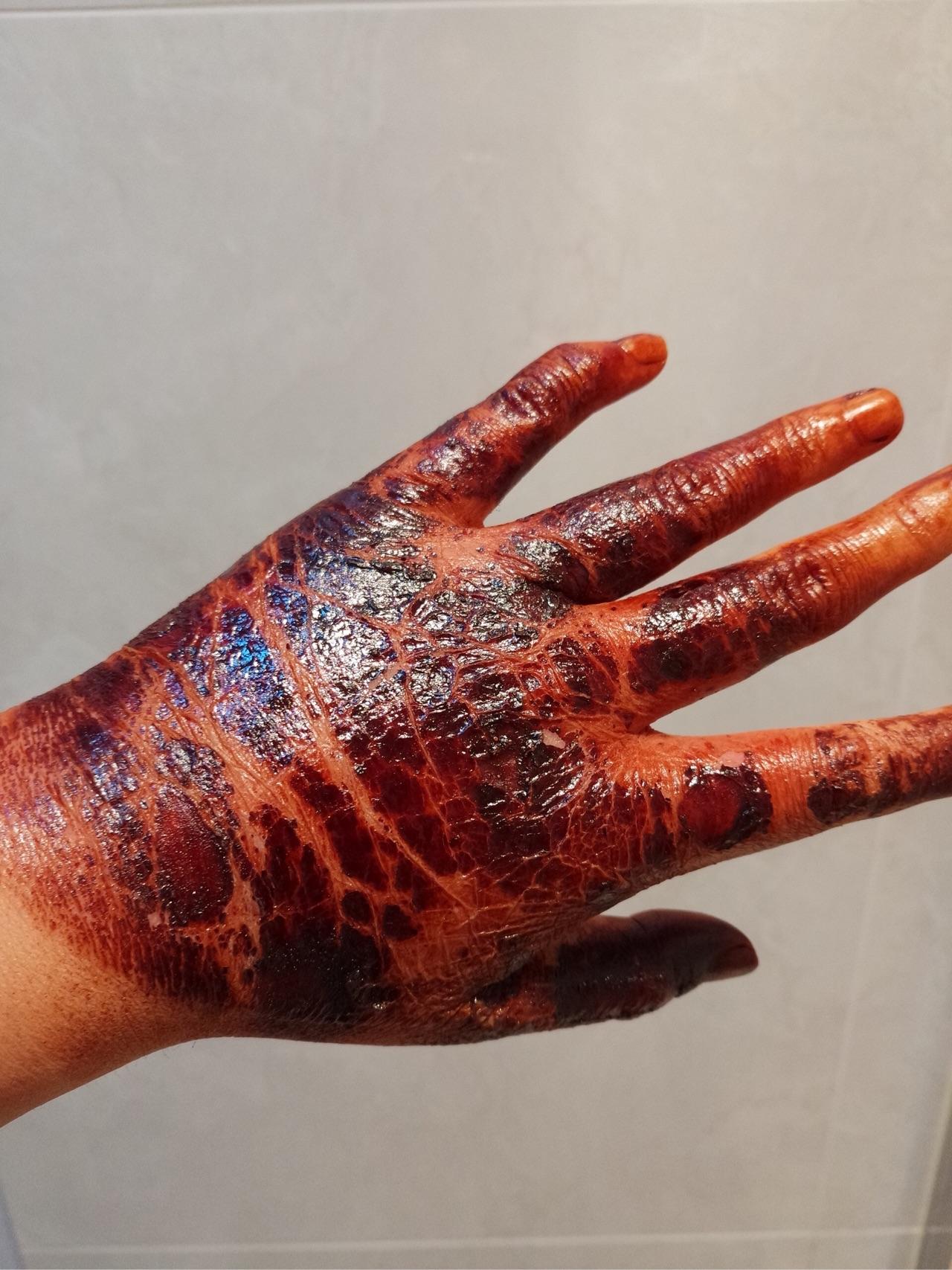 烫伤前后皮肤的具体变化是怎样的? - 知乎