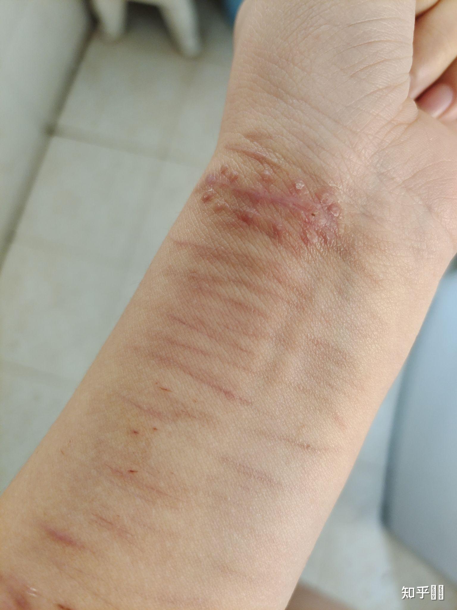 割腕的疤可以去掉吗? 