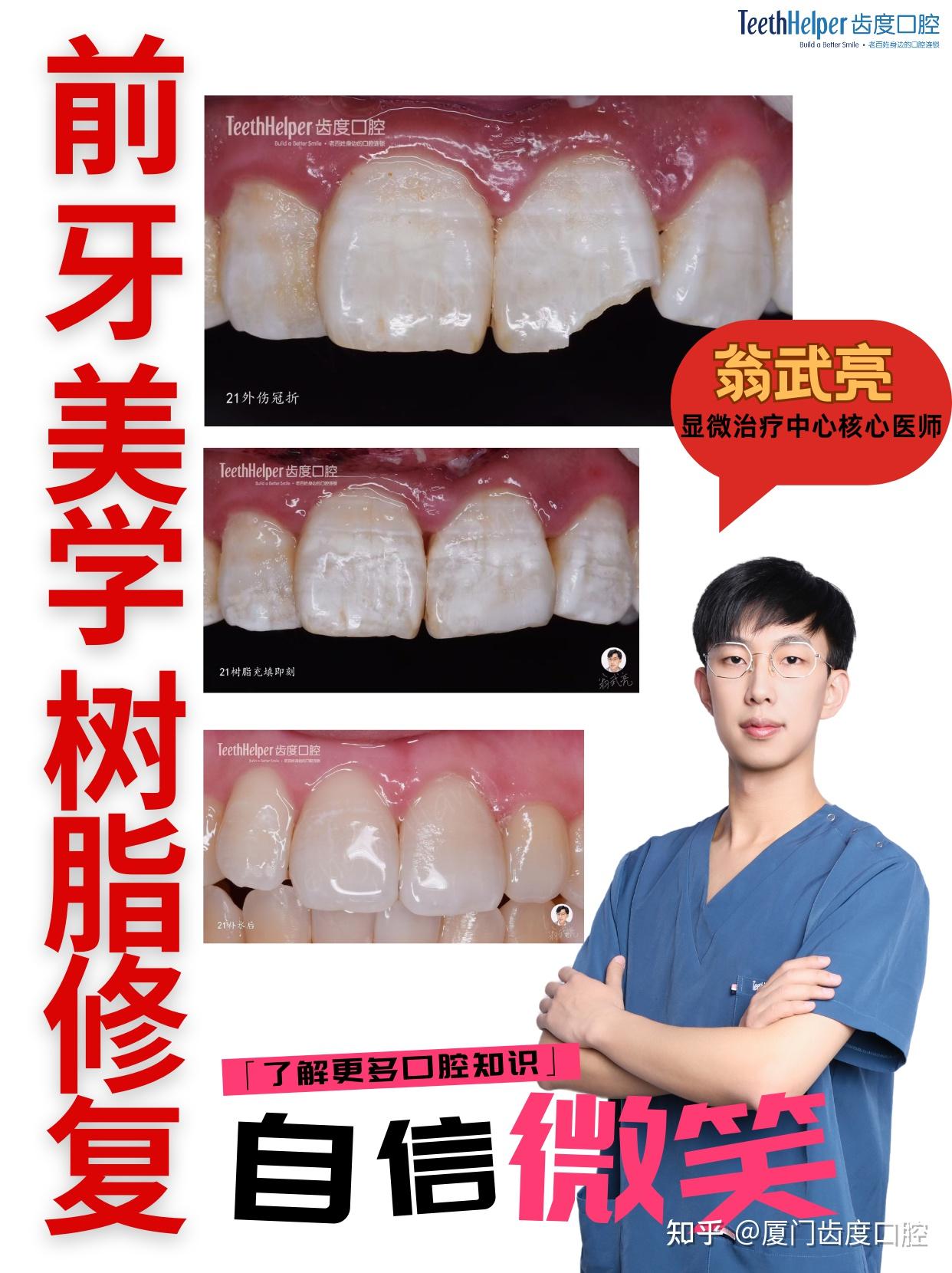 门牙缺了一块,有哪些补救方法? - 知乎