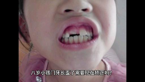 八岁小孩门牙长歪了需要现在就矫正吗?