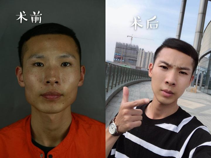 大小脸咬肌大下巴嘴歪的怎么办