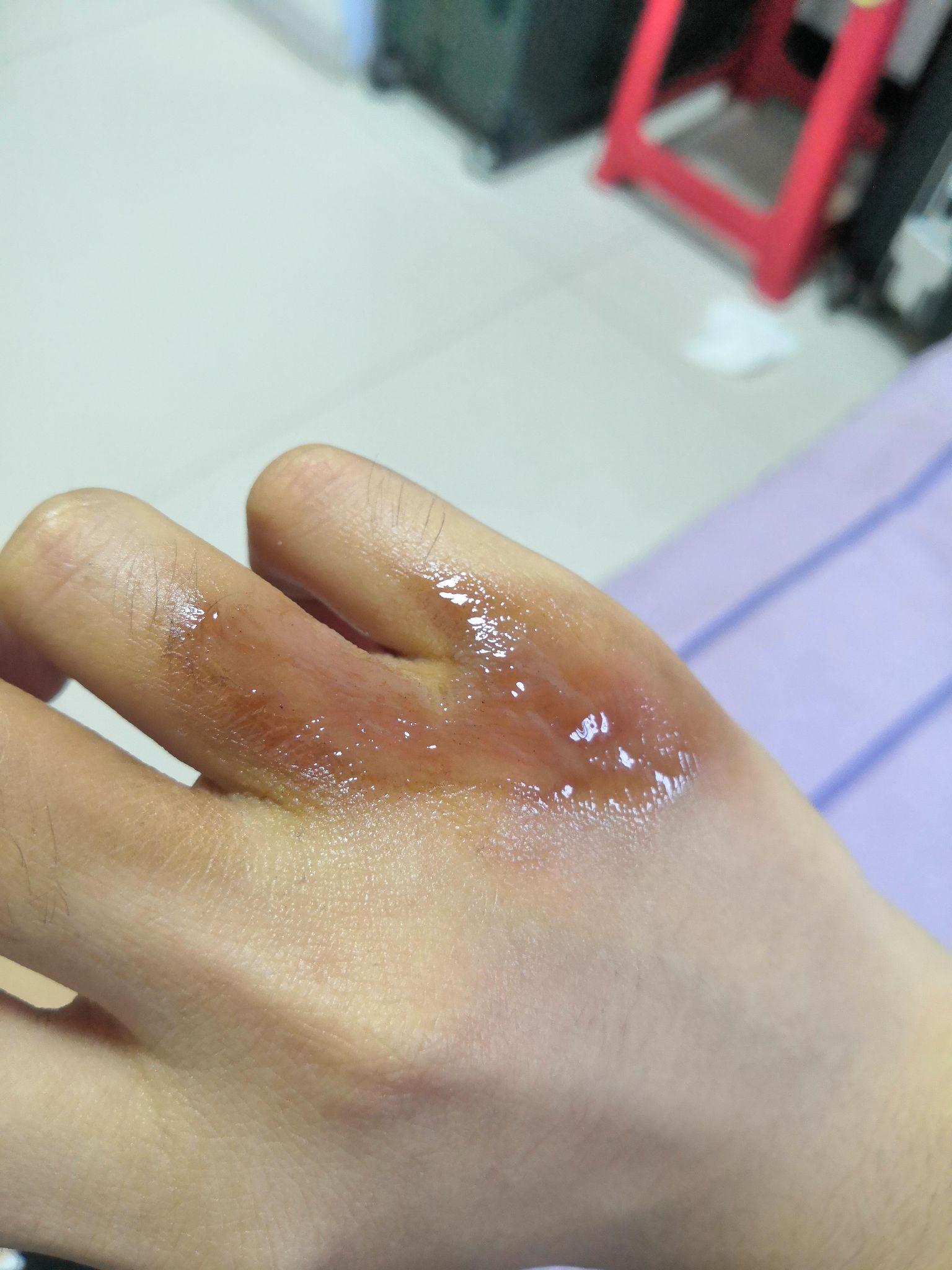手被水蒸气烫伤,怎么处置?