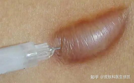 有没有打过疤痕增生软化针的老铁们